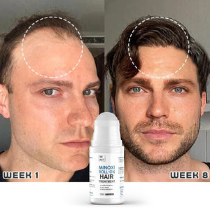 Minoxi Roll-On Hair Growth Serum