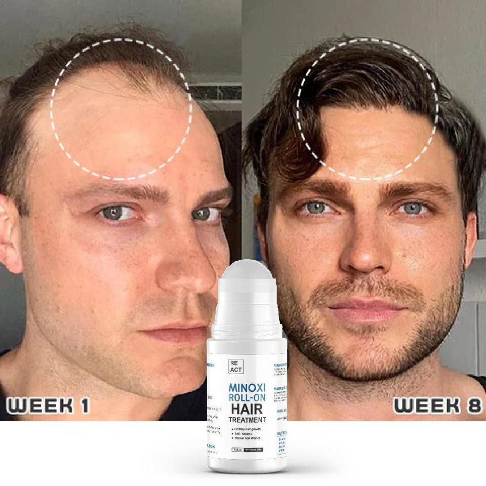 Minoxi Roll-On Hair Growth Serum